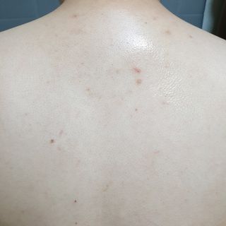 [후르디아] 등드름 잡는 바디 미스트 2개 세트 — 5점을 준 리뷰어가 2021년 7월 올린 사용 사진