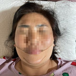 아이디플라코스메틱 아이디 페이스핏 마이너스 밴드 v2 — 5점을 준 리뷰어가 2021년 6월 올린 사용 사진