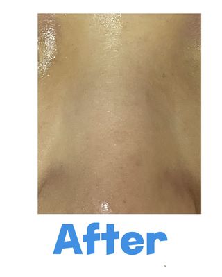 약손명가코스메틱 산 크리스타 퍼밍 설퍼 마스크팩 28g10ea — 5점을 준 리뷰어가 2022년 3월 올린 사용 사진