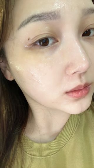 세뚜아(Cettua) 세뚜아 스티키 포어 패치 Cettua Sticky Pore Patch — 5점을 준 리뷰어가 2023년 11월 올린 사용 사진