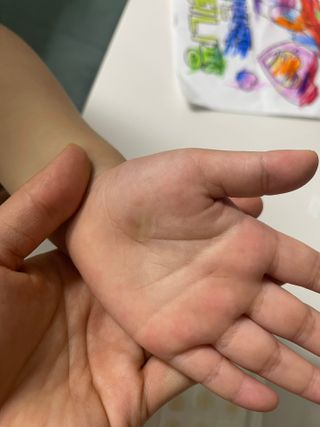 올리브영 엘라밴드 하이드로 도트 스팟패치 12mm, 티트리 — 5점을 준 리뷰어가 2022년 9월 올린 사용 사진