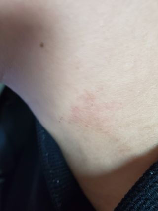 건선/아토/습진/민감성 피부 천연보습진정크림 소리온 크림 & 센시티브 크림 50g — 5점을 준 리뷰어가 2022년 2월 올린 사용 사진