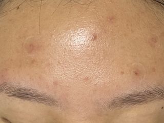 올리브영 엘라밴드 하이드로 도트 스팟패치 12mm, 티트리 — 5점을 준 리뷰어가 2022년 10월 올린 사용 사진