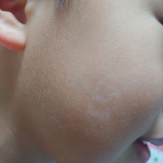 히루스카 포스트아크네 클리어 — 3점을 준 리뷰어가 2021년 2월 올린 사용 사진