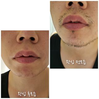 피비에스코리아 [오마이셀프] 셀프왁싱키트 — 5점을 준 리뷰어가 2021년 11월 올린 사용 사진