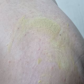 건선/아토/습진/민감성 피부 천연보습진정크림 소리온 크림 & 센시티브 크림 50g — 5점을 준 리뷰어가 2022년 3월 올린 사용 사진