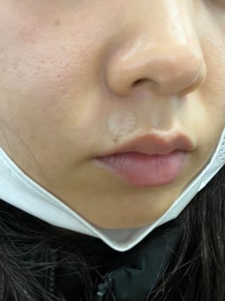 [큐어반H 스팟] 자외선 99프로 차단되는 스틱타입 스팟밴드(1팩 / 66매입) — 5점을 준 리뷰어가 2023년 1월 올린 사용 사진