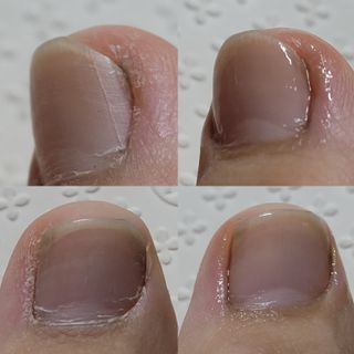 유케어 YOU CARE 문제성 손발톱케어_럭키풋 — 5점을 준 리뷰어가 2022년 10월 올린 사용 사진