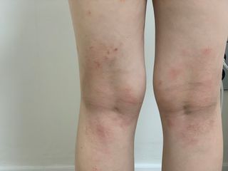 건선/아토/습진/민감성 피부 천연보습진정크림 소리온 크림 & 센시티브 크림 50g — 5점을 준 리뷰어가 2022년 1월 올린 사용 사진