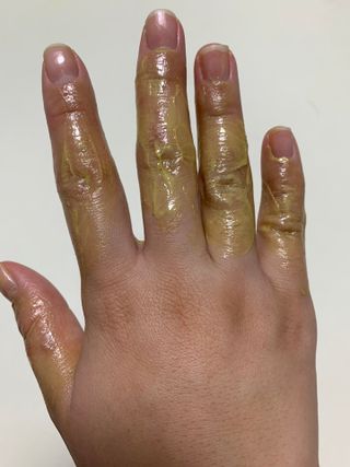 건선/아토/습진/민감성 피부 천연보습진정크림 소리온 크림 & 센시티브 크림 50g — 5점을 준 리뷰어가 2022년 1월 올린 사용 사진