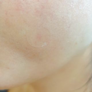 올리브영 엘라밴드 하이드로 도트 스팟패치 12mm, 티트리 — 4.5점을 준 리뷰어가 2022년 9월 올린 사용 사진