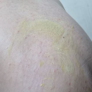 건선/아토/습진/민감성 피부 천연보습진정크림 소리온 크림 & 센시티브 크림 50g — 5점을 준 리뷰어가 2022년 3월 올린 사용 사진