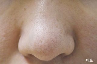 세뚜아(Cettua) 세뚜아 스티키 포어 패치 Cettua Sticky Pore Patch — 5점을 준 리뷰어가 2023년 9월 올린 사용 사진