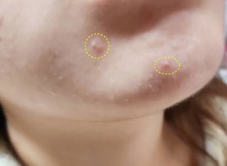 3M 넥스케어 블레미쉬 여드름패치 릴리프 111매(짜기 전 케어) +알코올스왑 증정 — 5점을 준 리뷰어가 2024년 5월 올린 사용 사진