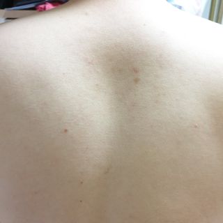 [후르디아] 등드름 잡는 바디 미스트 2개 세트 — 5점을 준 리뷰어가 2021년 7월 올린 사용 사진