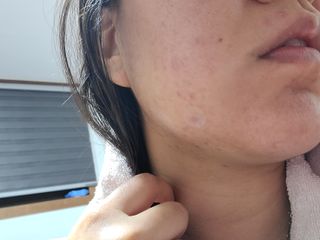 [큐어반H 스팟] 자외선 99프로 차단되는 스틱타입 스팟밴드(1팩 / 66매입) — 5점을 준 리뷰어가 2022년 12월 올린 사용 사진