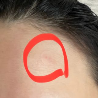 [큐어반H 스팟] 자외선 99프로 차단되는 스틱타입 스팟밴드(1팩 / 66매입) — 5점을 준 리뷰어가 2022년 11월 올린 사용 사진