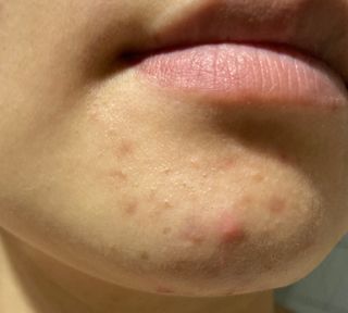 이엔코스 알부틴 알파 화이트닝크림 — 4점을 준 리뷰어가 2021년 4월 올린 사용 사진