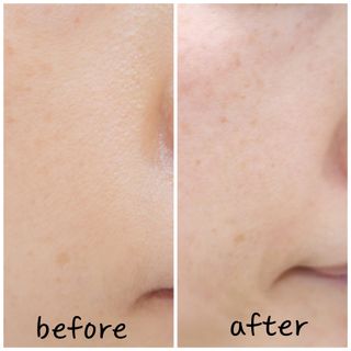 비알티씨 BRTC 시카 바이옴 블랙헤드 클렌징 폼 150ml — 5점을 준 리뷰어가 2022년 12월 올린 사용 사진