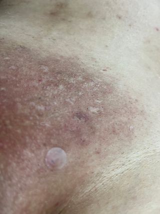 [큐어반H 스팟] 자외선 99프로 차단되는 스틱타입 스팟밴드(1팩 / 66매입) — 5점을 준 리뷰어가 2022년 11월 올린 사용 사진