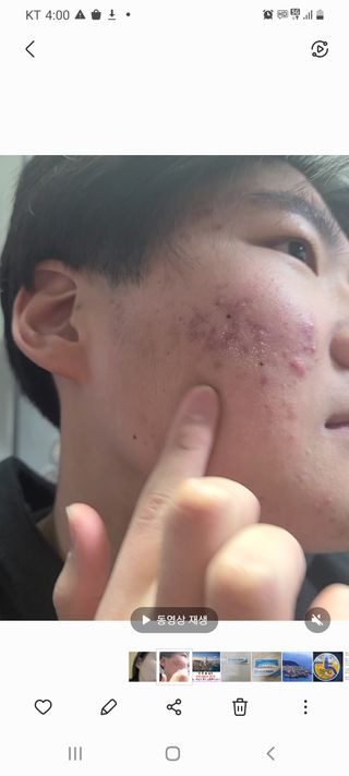히루스카 포스트아크네 클리어 — 5점을 준 리뷰어가 2021년 1월 올린 사용 사진