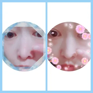 에버렐 아크네 클리어 패치 오리지널(40매) + XL(8매) 1세트, 각 1개씩 — 5점을 준 리뷰어가 2022년 5월 올린 사용 사진