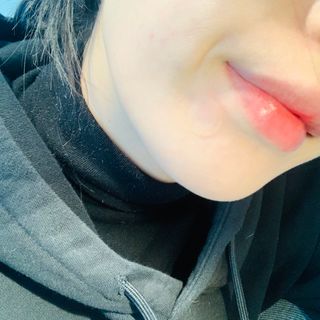 닥터플리너스 제로 트러블 패치 27ea — 5점을 준 리뷰어가 2022년 2월 올린 사용 사진
