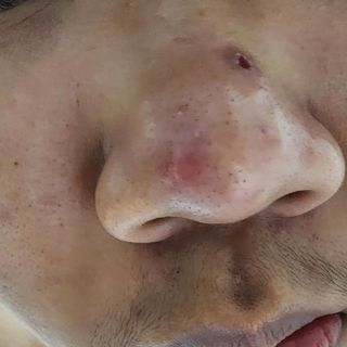 세뚜아(Cettua) 세뚜아 스티키 포어 패치 Cettua Sticky Pore Patch — 4점을 준 리뷰어가 2023년 10월 올린 사용 사진