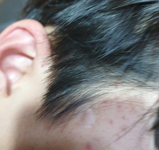 소담스퀘어 상암 디팩코퍼레이션 놀라아워 비건 하이드로콜로이드 클리어 패치 — 5점을 준 리뷰어가 2022년 12월 올린 사용 사진