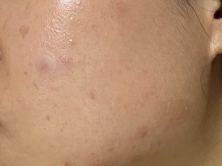 올리브영 엘라밴드 하이드로 도트 스팟패치 12mm, 티트리 — 5점을 준 리뷰어가 2022년 10월 올린 사용 사진