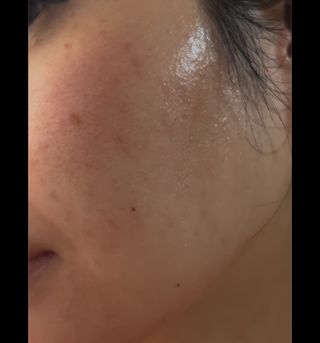 *✅프리 (블로그체험단) [밀리밀리] 메디 앰플 시카 15ml — 5점을 준 리뷰어가 2025년 9월 올린 사용 사진