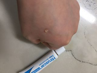 히루스카 포스트아크네 클리어 — 5점을 준 리뷰어가 2021년 1월 올린 사용 사진