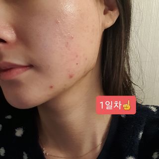 히루스카 포스트아크네 클리어 — 4점을 준 리뷰어가 2021년 1월 올린 사용 사진