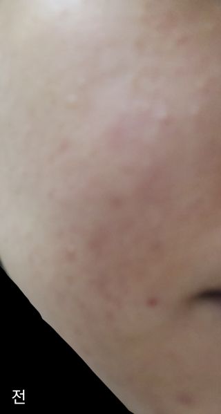 히루스카 포스트아크네 클리어 — 4점을 준 리뷰어가 2021년 1월 올린 사용 사진