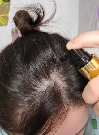 썸헤어 / SUMHAIR 썸헤어 써밋 안티 헤어로스 토닉 — 5점을 준 리뷰어가 2021년 5월 올린 사용 사진