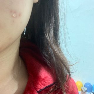 히루스카 포스트아크네 클리어 — 4.5점을 준 리뷰어가 2021년 1월 올린 사용 사진