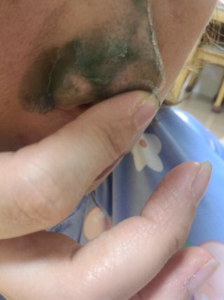 [후르디아] 저자극 필오프팩, 청포도 노즈팩 — 5점을 준 리뷰어가 2023년 8월 올린 사용 사진