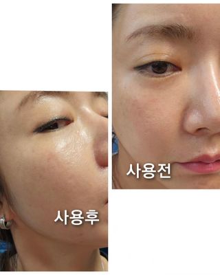 루트리 오디베리 5중 모공 리파이닝 앰플 — 5점을 준 리뷰어가 2023년 8월 올린 사용 사진