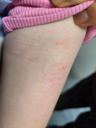 건선/아토/습진/민감성 피부 천연보습진정크림 소리온 크림 & 센시티브 크림 50g — 5점을 준 리뷰어가 2022년 2월 올린 사용 사진