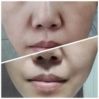 청담로즈 로즈블랑 화이트닝 슈퍼 리페어 리커버리 앰플 — 4.5점을 준 리뷰어가 2023년 7월 올린 사용 사진