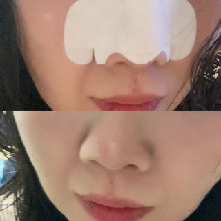 세뚜아(Cettua) 세뚜아 스티키 포어 패치 Cettua Sticky Pore Patch — 5점을 준 리뷰어가 2023년 8월 올린 사용 사진