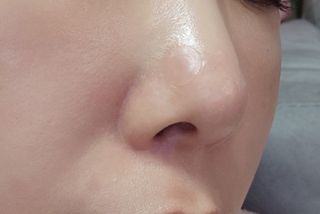 [큐어반H 스팟] 자외선 99프로 차단되는 스틱타입 스팟밴드(1팩 / 66매입) — 5점을 준 리뷰어가 2022년 11월 올린 사용 사진