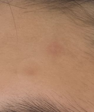3M 넥스케어 블레미쉬 여드름패치 릴리프 111매(짜기 전 케어) +알코올스왑 증정 — 5점을 준 리뷰어가 2024년 5월 올린 사용 사진
