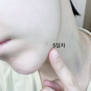 히루스카 포스트아크네 클리어 — 5점을 준 리뷰어가 2021년 2월 올린 사용 사진