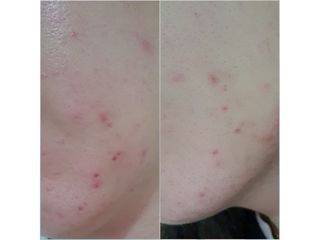 히루스카 포스트아크네 클리어 — 5점을 준 리뷰어가 2020년 12월 올린 사용 사진