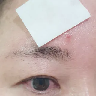 3M 넥스케어 블레미쉬 여드름패치 릴리프 111매(짜기 전 케어) +알코올스왑 증정 — 5점을 준 리뷰어가 2024년 7월 올린 사용 사진