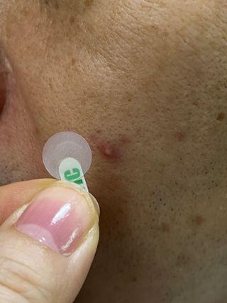 [큐어반H 스팟] 자외선 99프로 차단되는 스틱타입 스팟밴드(1팩 / 66매입) — 5점을 준 리뷰어가 2022년 11월 올린 사용 사진