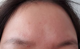 마이디플러스 트러블 릴리프 케어 마이크로 패치 1박스 2매 — 5점을 준 리뷰어가 2021년 11월 올린 사용 사진