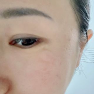 세뚜아(Cettua) 세뚜아 스팟 클리어 듀얼 패치 Cettua Spot Clear Dual Patch — 5점을 준 리뷰어가 2023년 7월 올린 사용 사진