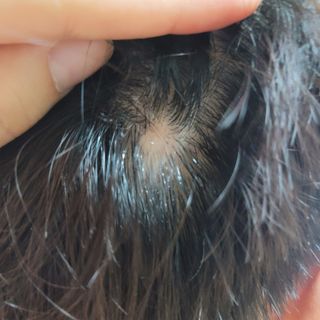 썸헤어 / SUMHAIR 썸헤어 써밋 안티 헤어로스 토닉 — 5점을 준 리뷰어가 2021년 5월 올린 사용 사진